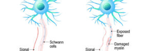 Graphic of healthy neuron vs a neuron damaged by MS